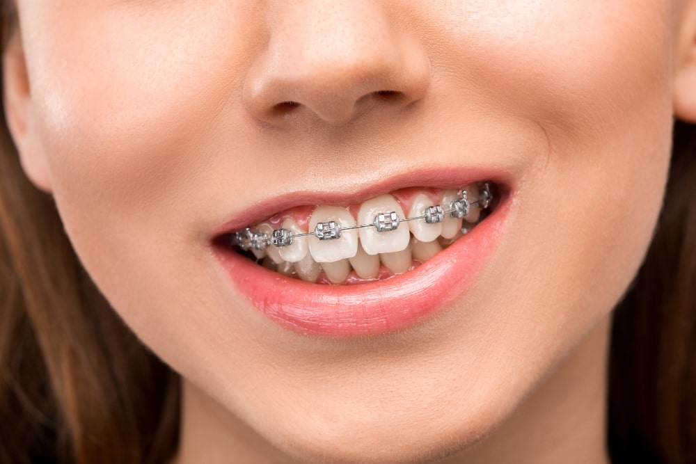 How to Clean Invisalign Properly