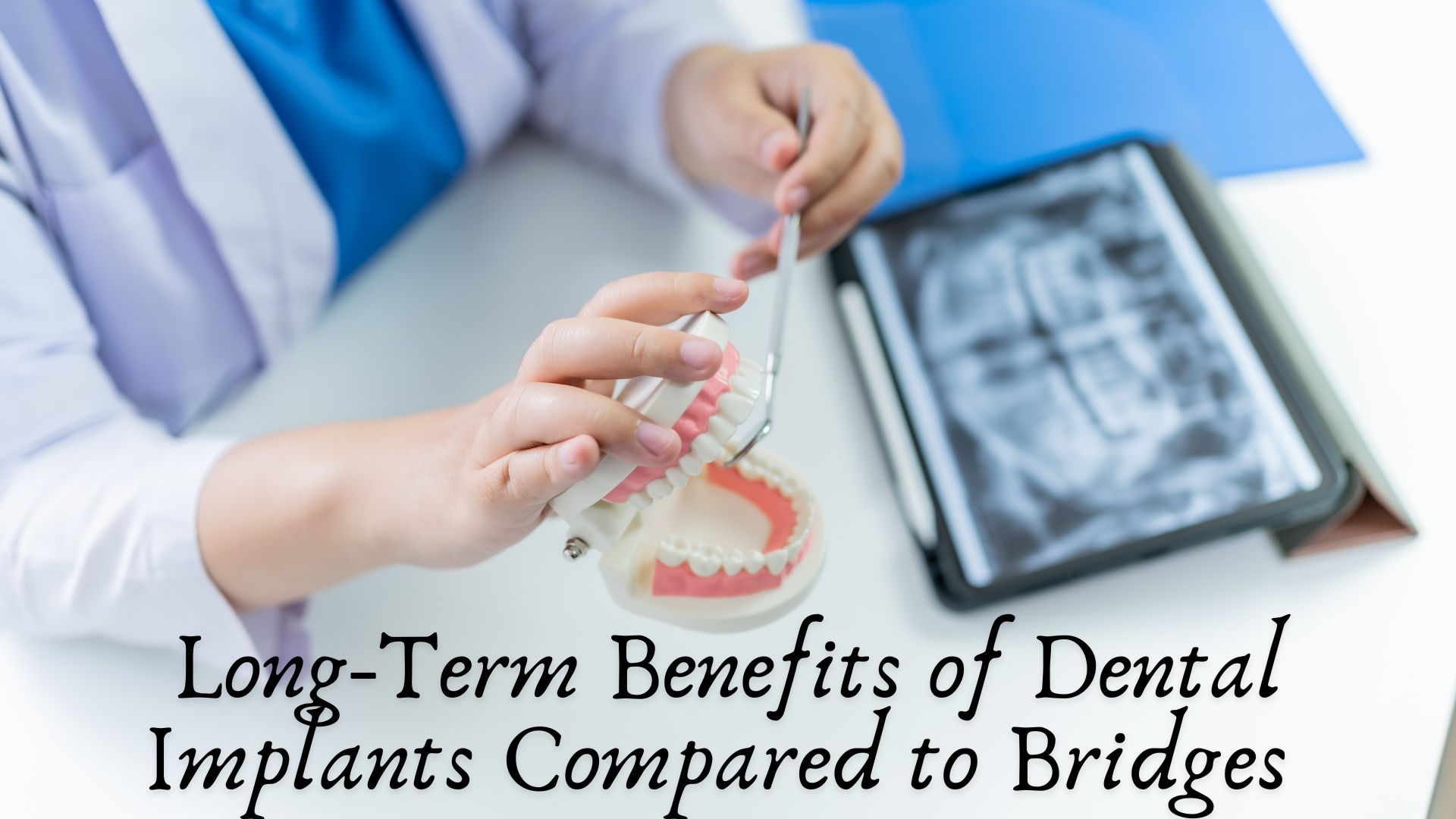 Long-Term Benefits of Dental Implants Compared to Bridges