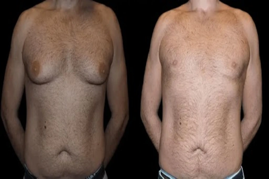 Before and After Male Breast Reduction Result