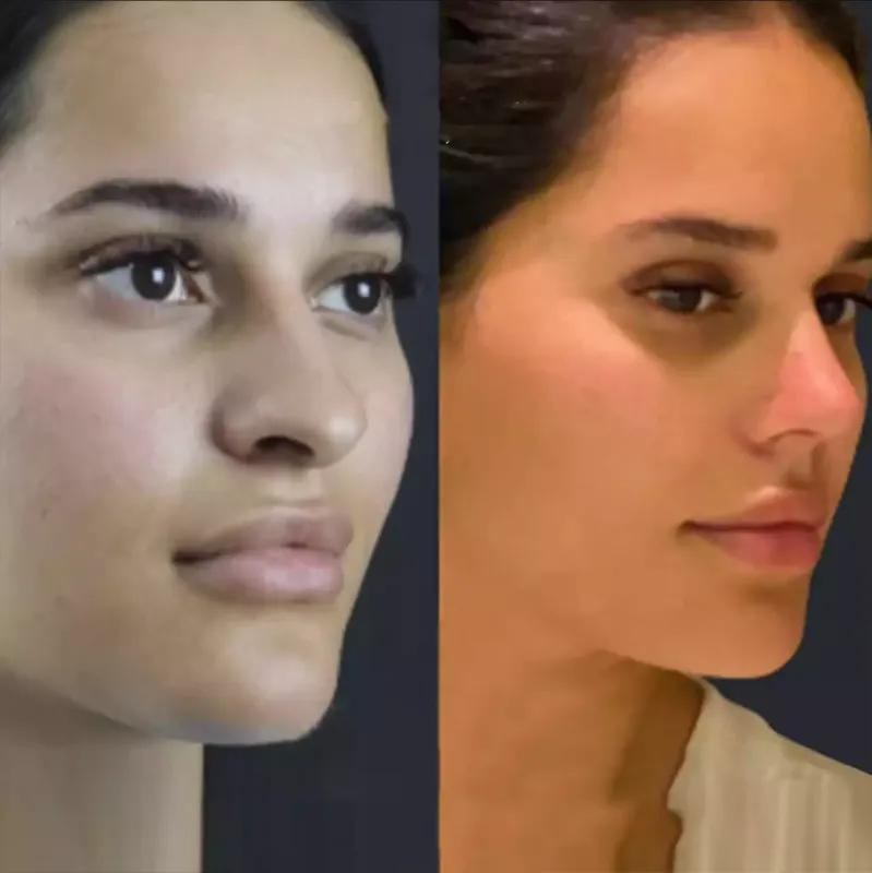 Rhinoplasty in Dubai: Understanding the Role of Anesthesia