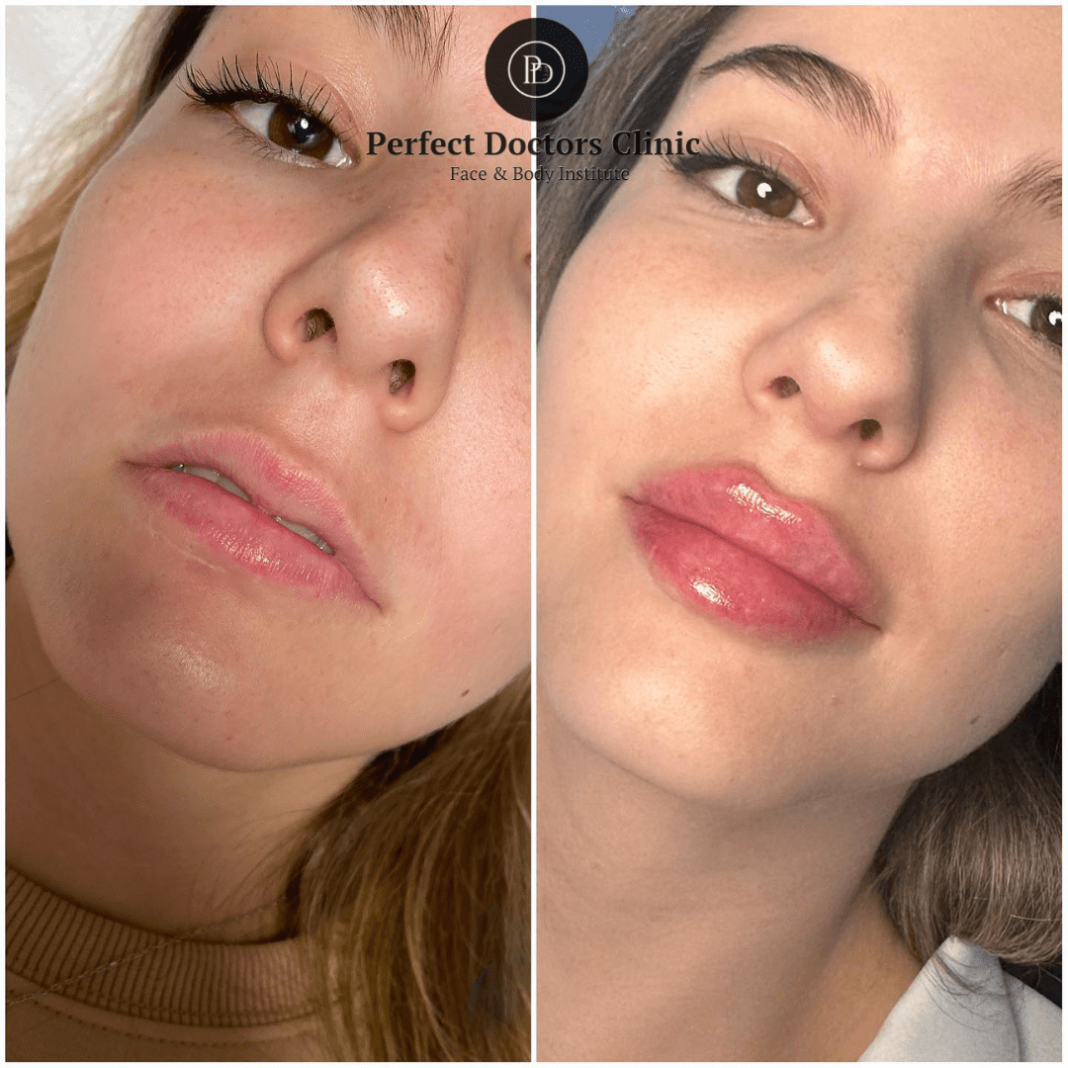 Juvederm fillers