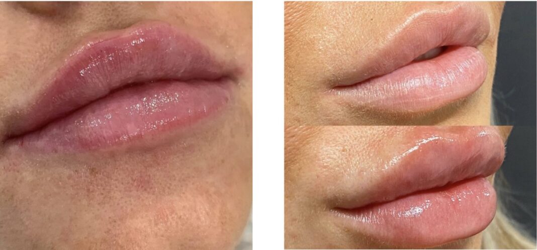 The Russian Lip Filler Technique: A Modern Marvel in Aesthetic Medicine