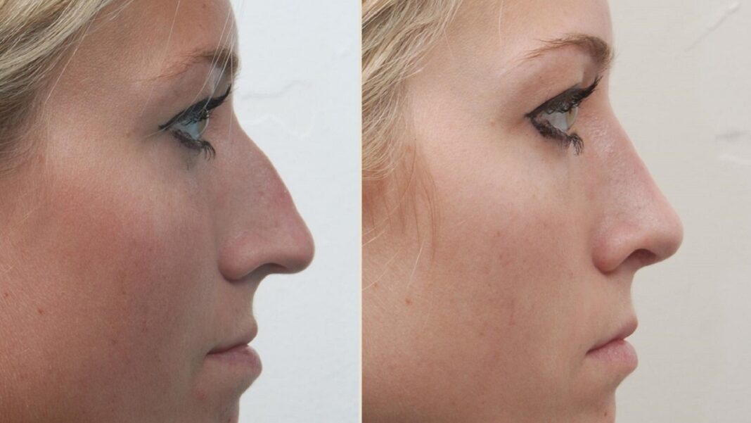 Liquid rhinoplasty