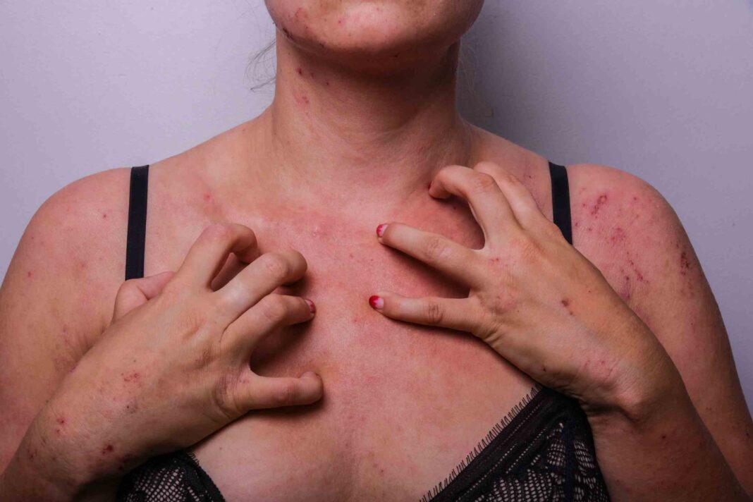 eczema on breast