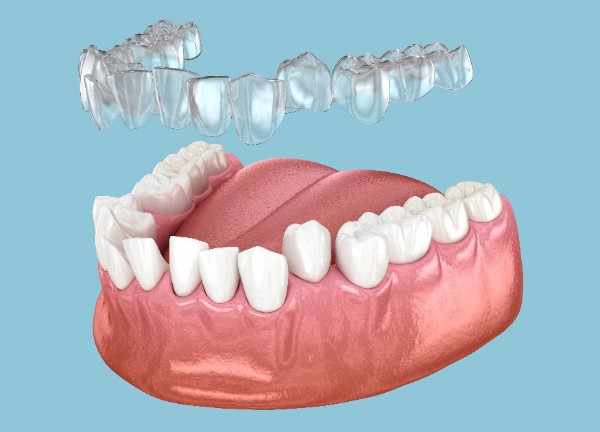 invisalign Kendal